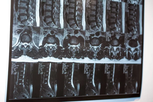Magnetic resonance tomography (MRT) of the lumbar spine. Hernia