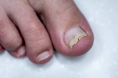 Onycholysis beyaz arka plan üzerinde izole. T mekanik hasar