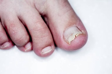 Onycholysis beyaz arka plan üzerinde izole. T mekanik hasar