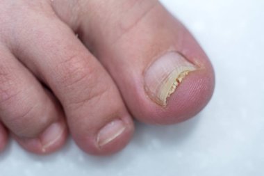 Onycholysis beyaz arka plan üzerinde izole. T mekanik hasar
