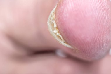 Onycholysis beyaz arka plan üzerinde izole. T mekanik hasar