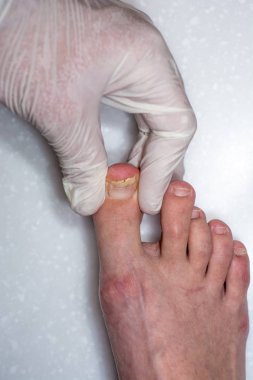 Onycholysis beyaz arka plan üzerinde izole. Doktonun elleri