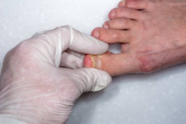 Onycholysis beyaz arka plan üzerinde izole. Doktonun elleri
