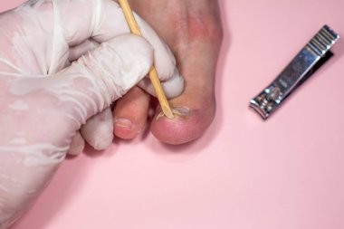 Onycholysis pembe arka plan üzerinde izole. Doktorun elleri