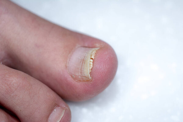 Onycholysis isolated on white background. Mechanical damage to t