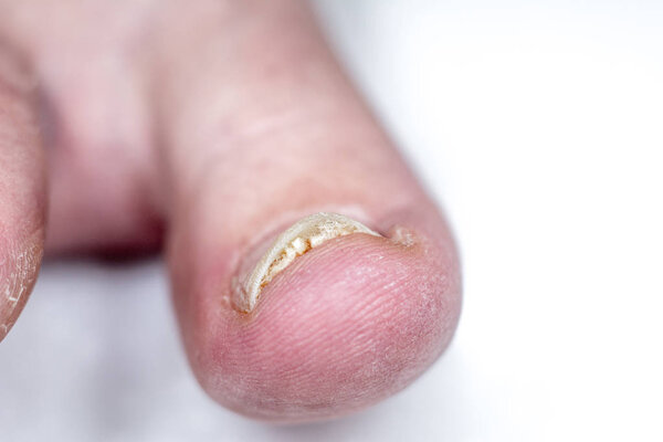 Onycholysis isolated on white background. Mechanical damage to t