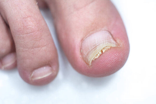 Onycholysis isolated on white background. Mechanical damage to t