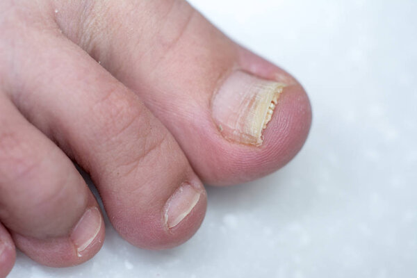 Onycholysis isolated on white background. Mechanical damage to t