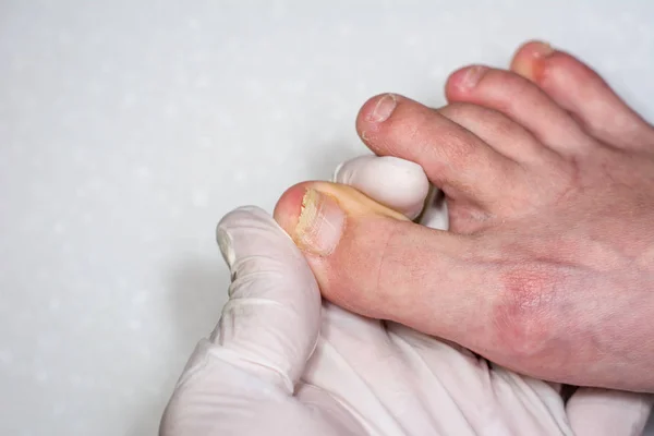 Onycholyse geïsoleerd op witte achtergrond. De handen van de Docto — Stockfoto