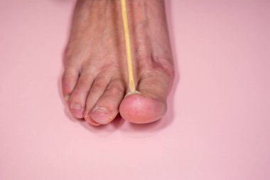 Onycholysis pembe arka plan üzerinde izole. Mekanik hasar th