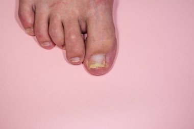 Onycholysis pembe arka plan üzerinde izole. Mekanik hasar th