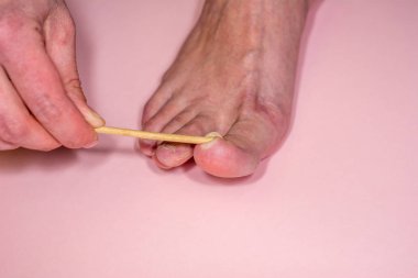 Onycholysis pembe arka plan üzerinde izole. Mekanik hasar th