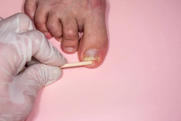 Onycholysis pembe arka plan üzerinde izole. Doktorun elleri