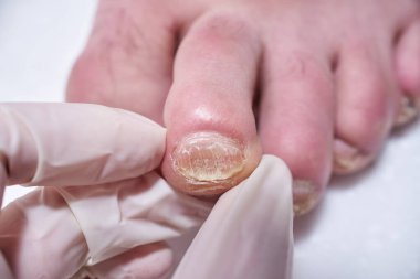 Ayak hastalıkları uzmanı ameliyat sırasında ayakları tedavi eder, ayağı muayene eder. Profesyonel tıbbi pedikür. Ayak hastalıkları kliniği ayak tedavisi.