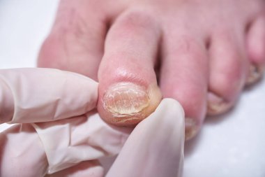 Ayak hastalıkları uzmanı ameliyat sırasında ayakları tedavi eder, ayağı muayene eder. Profesyonel tıbbi pedikür. Ayak hastalıkları kliniği ayak tedavisi.