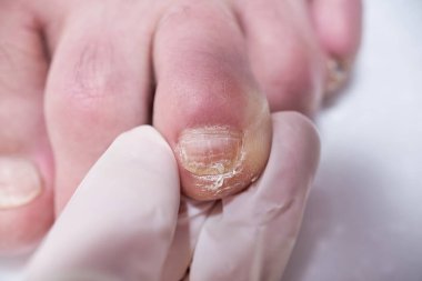 Ayak hastalıkları uzmanı ameliyat sırasında ayakları tedavi eder, ayağı muayene eder. Profesyonel tıbbi pedikür. Ayak hastalıkları kliniği ayak tedavisi.