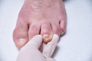 Ayak hastalıkları uzmanı ameliyat sırasında ayakları tedavi eder, ayağı muayene eder. Profesyonel tıbbi pedikür. Ayak hastalıkları kliniği ayak tedavisi.