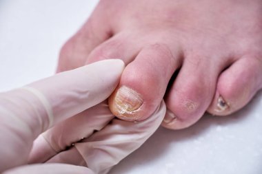 Ayak hastalıkları uzmanı ameliyat sırasında ayakları tedavi eder, ayağı muayene eder. Profesyonel tıbbi pedikür. Ayak hastalıkları kliniği ayak tedavisi.
