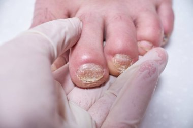 Ayak hastalıkları uzmanı ameliyat sırasında ayakları tedavi eder, ayağı muayene eder. Profesyonel tıbbi pedikür. Ayak hastalıkları kliniği ayak tedavisi.