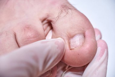 Doktor-ayak hastalıkları uzmanı klinikte hastanın ayağını muayene ediyor. Ayak tırnağı mantarını tedavi eden pediatrist. Podoloji tedavisi.