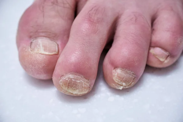 Clavos Masculinos Destruidos Por Onicolisis Daño Las Uñas Los Pies — Foto de Stock