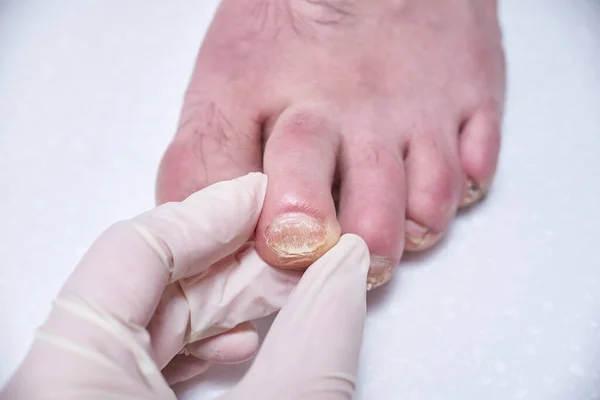 Podiatr Léčí Nohy Během Procedury Vyšetřuje Nohu Profesionální Lékařská Pedikúra — Stock fotografie