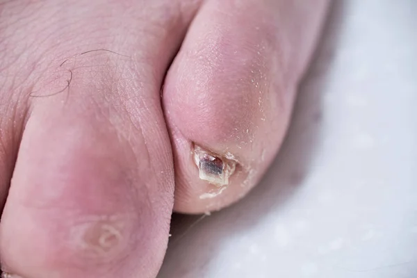 被迷奸药毁掉的男性指甲男性脚指甲受损 在皮肤科医生那儿教育和治疗 在白色的腿特写上隔离 — 图库照片