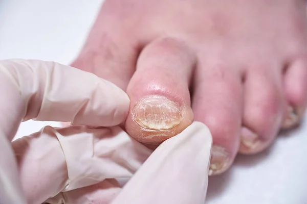 Ποδίατρος Θεραπεύει Πόδια Κατά Διάρκεια Της Επέμβασης Εξετάζει Πόδι Επαγγελματικό — Φωτογραφία Αρχείου