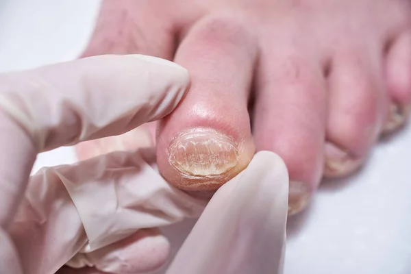 Ayak hastalıkları uzmanı ameliyat sırasında ayakları tedavi eder, ayağı muayene eder. Profesyonel tıbbi pedikür. Ayak hastalıkları kliniği ayak tedavisi.