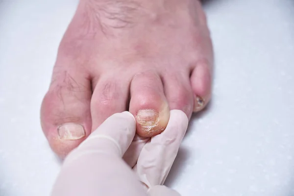 Ayak hastalıkları uzmanı ameliyat sırasında ayakları tedavi eder, ayağı muayene eder. Profesyonel tıbbi pedikür. Ayak hastalıkları kliniği ayak tedavisi.