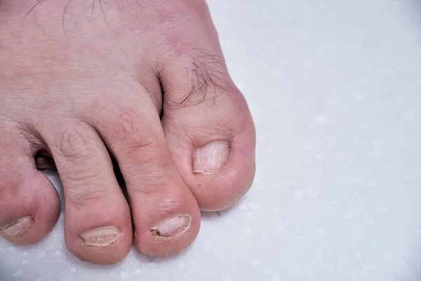 Αρσενικά Νύχια Καταστράφηκαν Από Ονυχόλυση Βλάβη Στα Αρσενικά Νύχια Ποδιών — Φωτογραφία Αρχείου