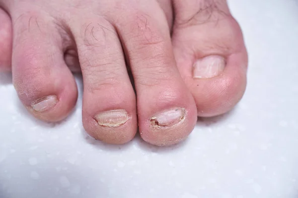 Mannelijke Nagels Vernietigd Door Onycholyse Schade Aan Mannelijke Voetnagels Bij — Stockfoto
