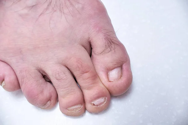Paznokcie Zniszczone Przez Onycholizę Uszkodzenie Męskich Paznokci Stóp Dermatologa Pedicure — Zdjęcie stockowe