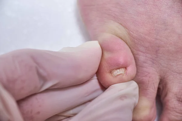Lékař Podiatr Vyšetřuje Pacientovu Nohu Klinice Podiatr Léčí Plíseň Nehtů — Stock fotografie