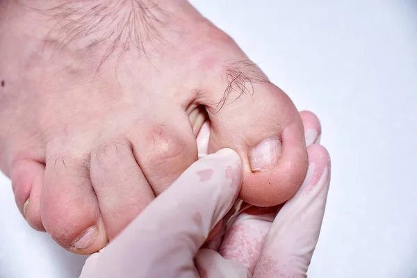 The doctor-podiatrist does an examination  of the patient\'s foot in the clinic. Podiatrist treating toenail fungus. Podology treatment.