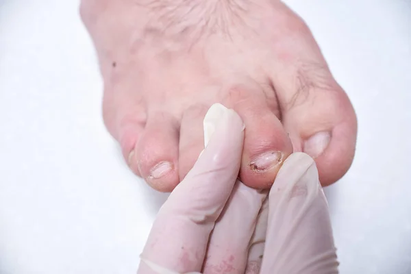 Γιατρός Ποδίατρος Εξετάζει Πόδι Του Ασθενούς Στην Κλινική Ποδίατρος Θεραπεύει — Φωτογραφία Αρχείου