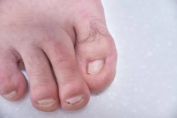 Paznokcie Zniszczone Przez Onycholizę Uszkodzenie Męskich Paznokci Stóp Dermatologa Pedicure Obrazek Stockowy