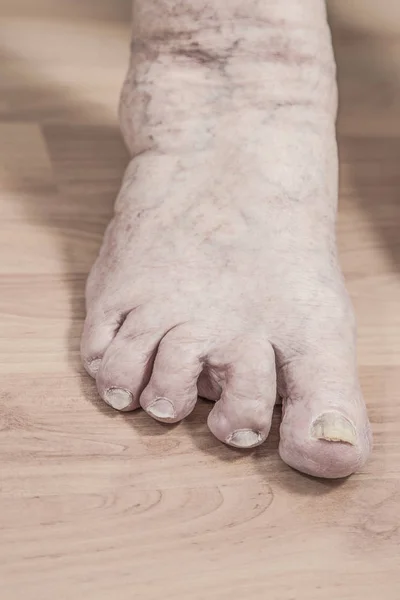 Închiderea Piciorului Unei Persoane Vârstă Artrită Unghii Deteriorate Piciorul Atletului — Fotografie, imagine de stoc