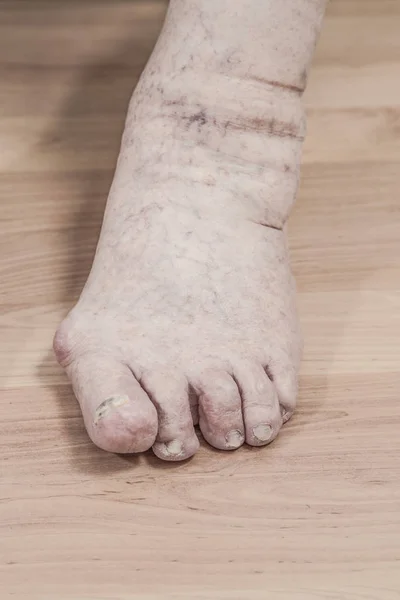 Închiderea Piciorului Unei Persoane Vârstă Artrită Unghii Deteriorate Piciorul Atletului — Fotografie, imagine de stoc