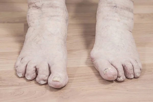 Închiderea Picioarelor Unei Persoane Vârstă Artrită Unghiile Deteriorate Picioarele Atletului — Fotografie, imagine de stoc