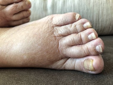pulmoner ödem ve hasarlı tırnakları olan bir hastanın ayakları beca
