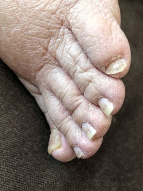 female foot with damaged nails because of fungus clipart