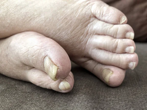 Picioare feminine cu unghii deteriorate din cauza ciupercilor — Fotografie, imagine de stoc
