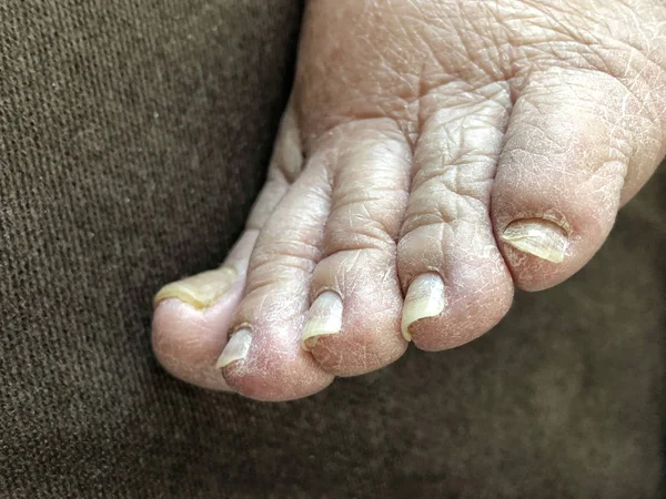 Pie femenino con las uñas dañadas debido a los hongos — Foto de Stock