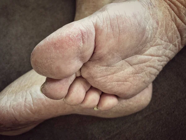 Picioare ale unei femei bolnave în vârstă cu piele uscată — Fotografie, imagine de stoc