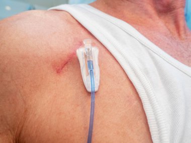 Vana ve eklem bağlantı için kemoterapi için implante edilebilir bağlantı noktasına intravenöz sıvı enjeksiyon ile tüp