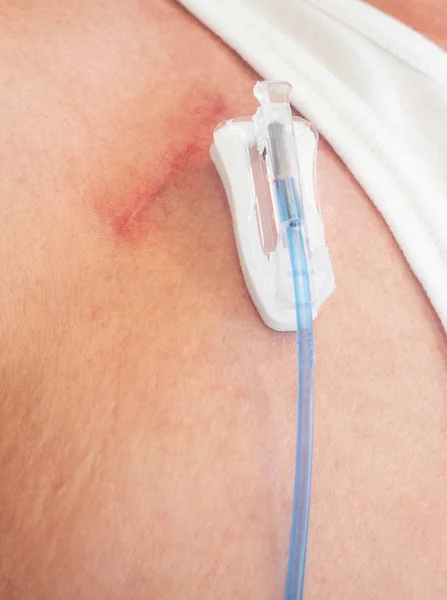 Tube Valve Joint Connection Intravenous Fluids Injections Implantable Port Chemotherapy — Stock Photo, Image