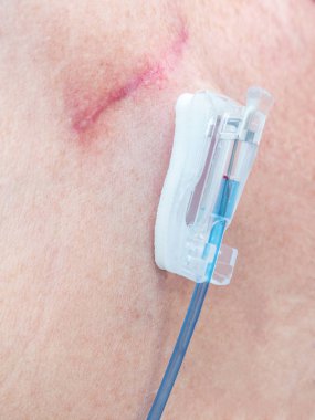 Vana ve eklem bağlantı için kemoterapi için implante edilebilir bağlantı noktasına intravenöz sıvı enjeksiyon ile tüp