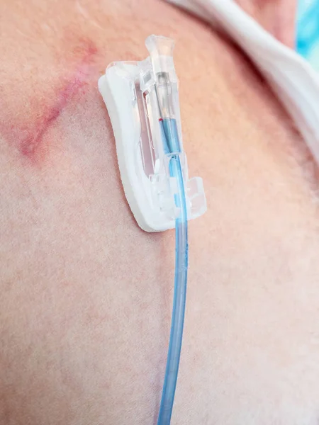 Tube Valve Joint Connection Intravenous Fluids Injections Implantable Port Chemotherapy — Stock Photo, Image