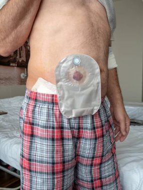 Patient demonstrates ileostomy on his stomach while standing in a hospital ward. clipart
